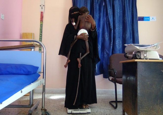 11月，也門女子Nadia Nahari抱著5歲的兒子Abdelrahman Manhash。由於嚴重營養不良，兒子體重僅有5公斤。Nadia抱著他在也門北部荷台達（Hodeidah）一家診所秤體重。